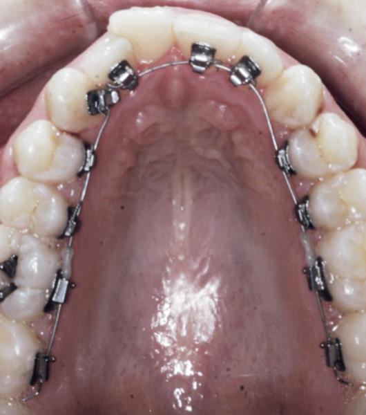 Ortodoncia lingual con arco recto